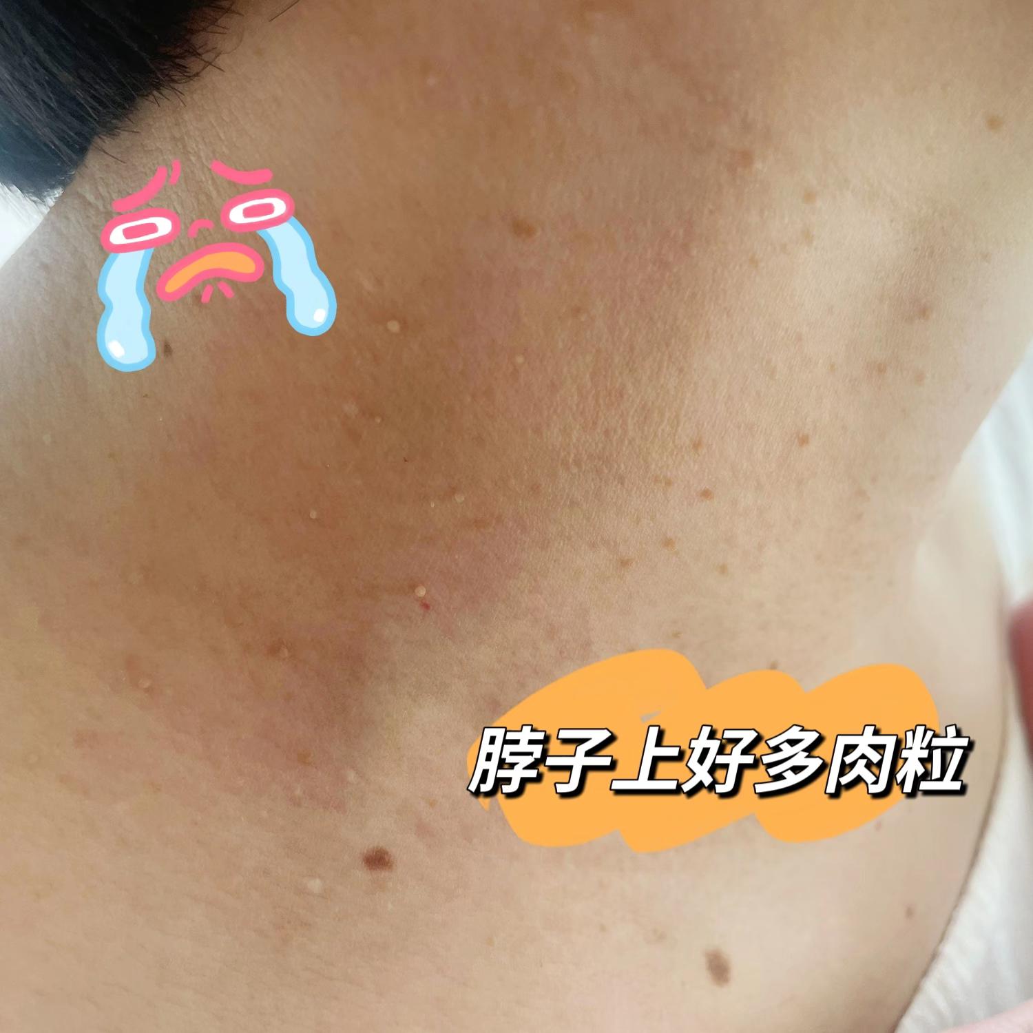 脖子上长丝状疣。别扣了#丝状疣 #丝状疣祛除 #小肉粒 #扁平疣 #脖子上的小肉粒