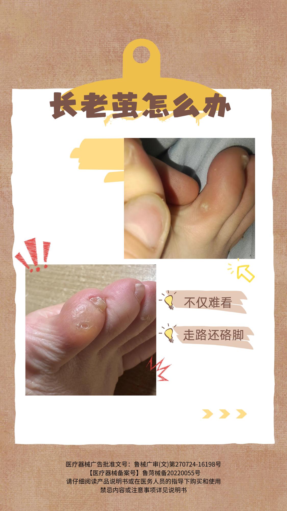 长老茧怎么办。老茧不仅硌脚,走路还痛,你试试这一招#老茧 #老茧怎么去除 #鸡眼 #鸡眼去除小妙招 #足部护理
