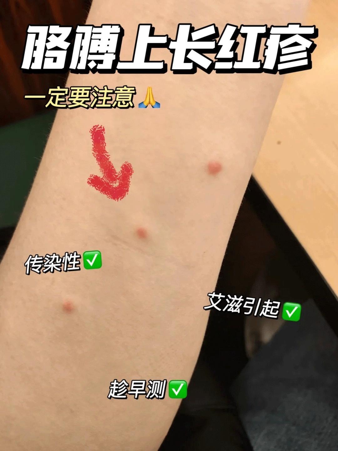 艾滋红疹在胳膊上安家?!别慌!检测试纸来了!#艾滋病 #艾滋病传播途径 #艾滋病检测 #恐艾 #传染病