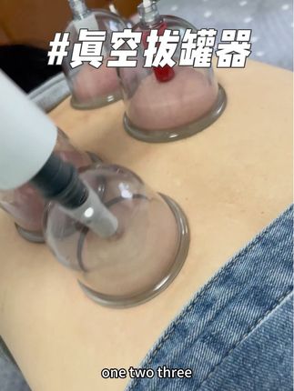 #拔罐