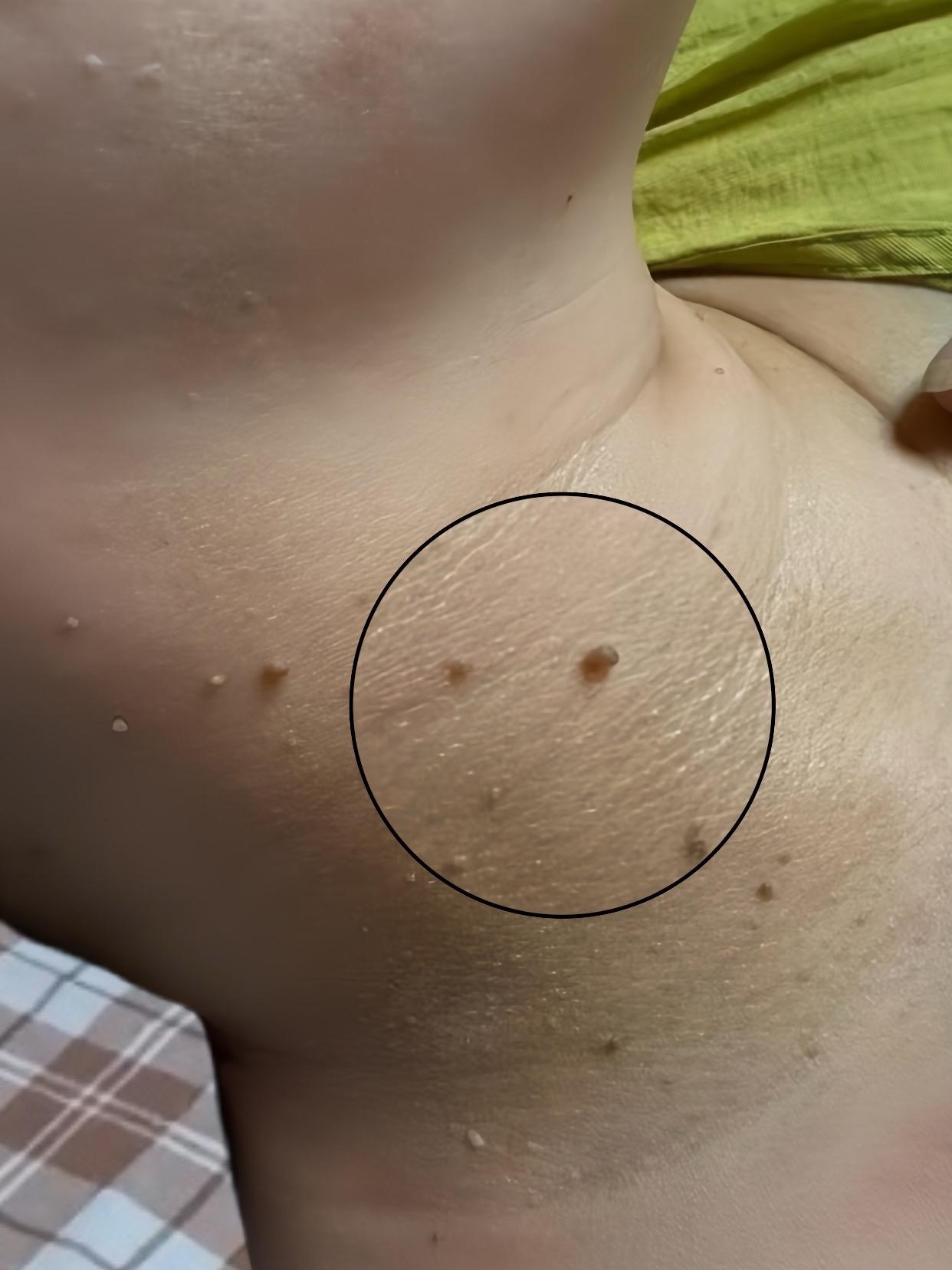 #脖子上的小肉粒 姐妹们,既然不戴项链,脖子也要美美哒