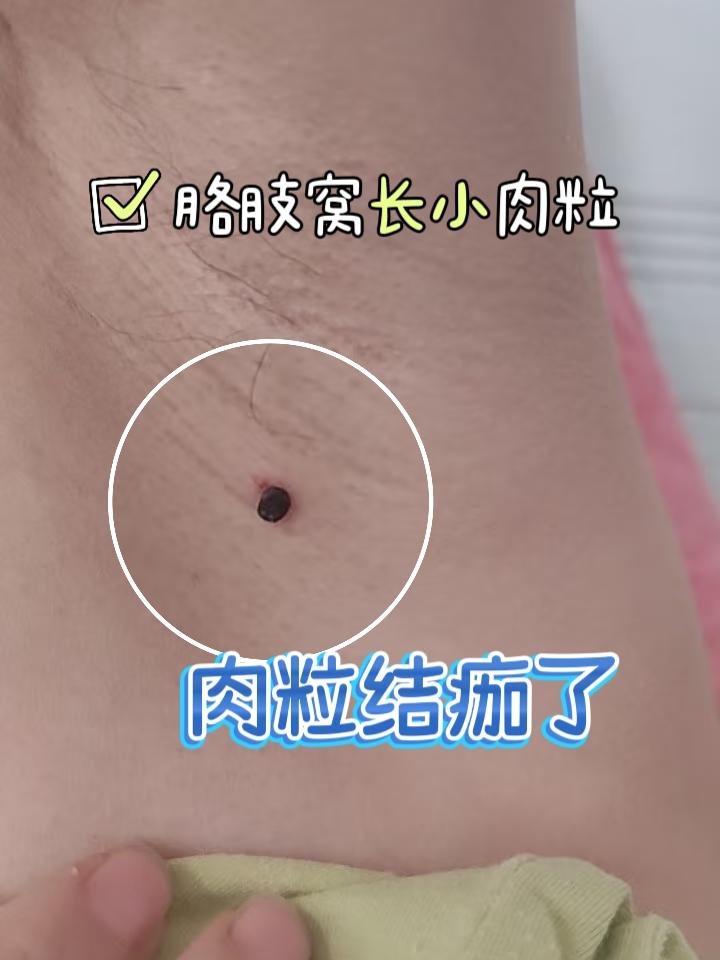腋下长小肉粒?拜拜👋。#小肉粒 #扁平疣 #丝状疣 #丝状疣祛除 #脖子上的小肉粒