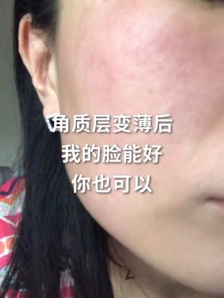 以前护肤品用的太复杂,导致角质层变薄,一遇冷遇热一激动就又红又痒,直到用了这款精华,慢慢修护增厚了角质层,再也不用担心了。#角质层薄 #红血丝 #敏感肌护肤 #秋季护肤#大红脸