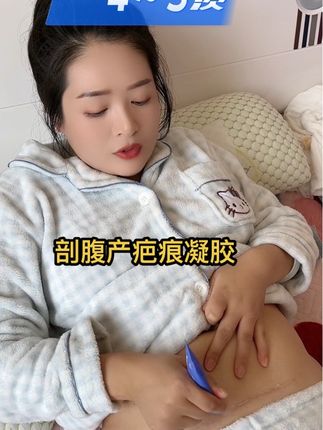 #宝妈分享 每天坚持涂凝胶四到五次#剖腹产疤痕 #剖腹产妈妈