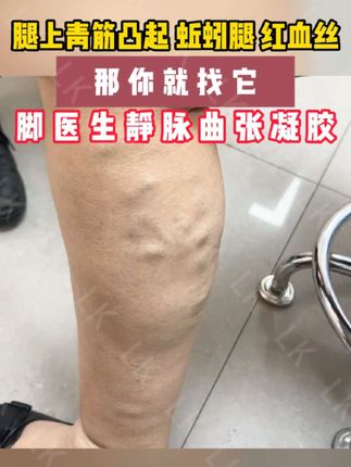 腿上#静脉曲张 #青筋凸起 #蚯蚓腿 #红血丝 #酸麻胀痛 你就找它,脚医生静脉曲张凝胶,静脉曲张的死对头