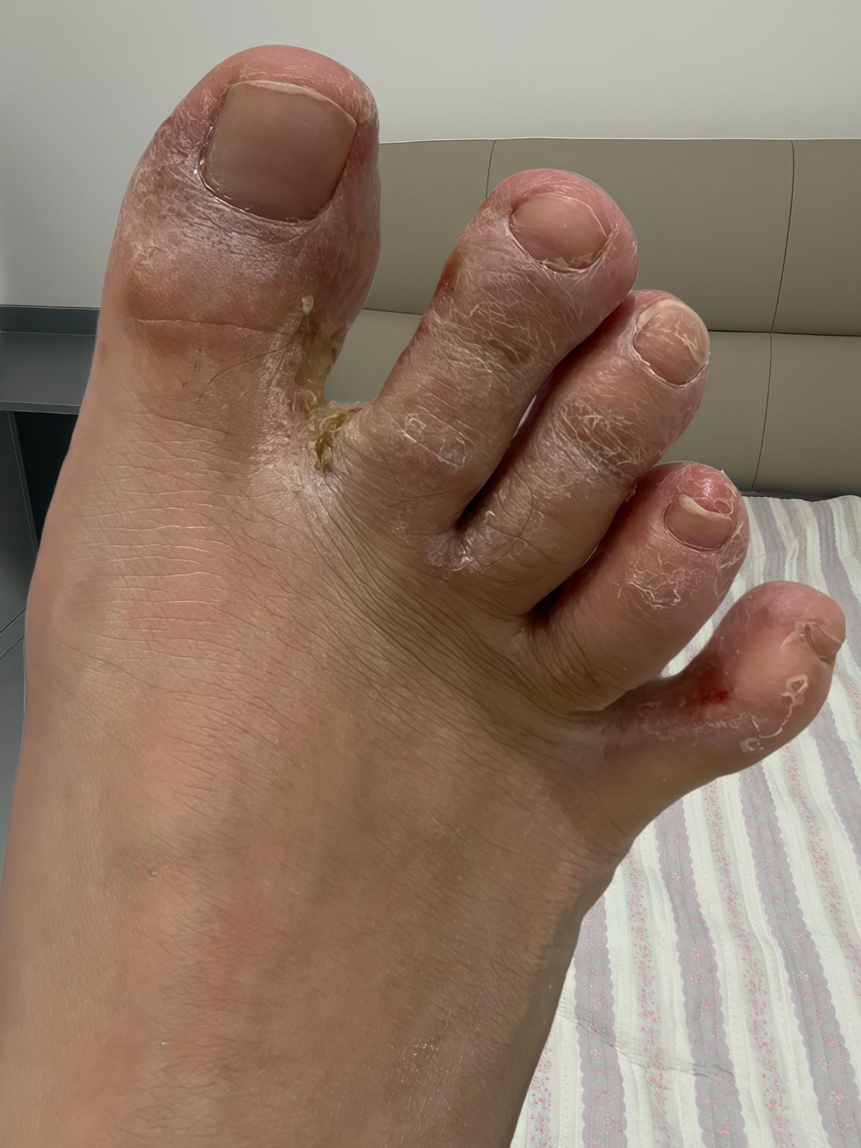 太开心了🥳终于不痒了#脚丫子 #可爱的小脚丫 #无处安放的小脚丫 #我的脚脚