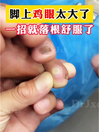鸡眼越长越大,千万别拖着不管,处理很简单!#鸡眼 #鸡眼跖疣 #鸡眼去除小妙招 #鸡眼机 #鸡眼扣