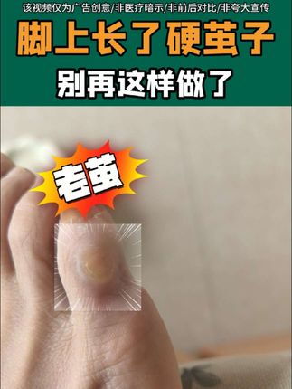 脚上老茧别再修,试试这一招#老茧 #老茧怎么去除 #鸡眼 #鸡眼去除小妙招 #足部护理