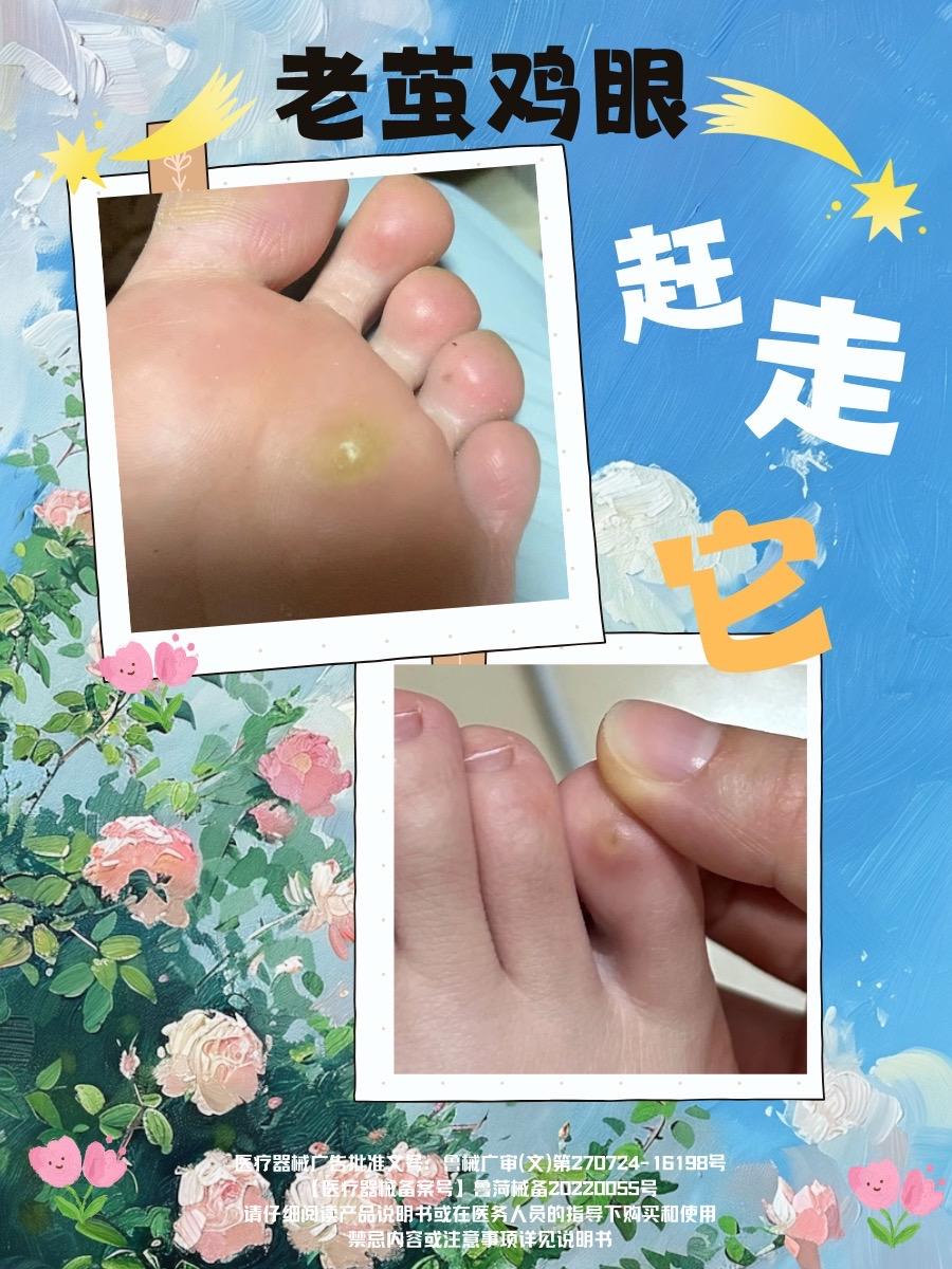 脚底长了老茧怎么办。#脚底长了老茧怎么去除 #老茧怎么去除 #老茧软化剂 #老茧痛怎么办 #老茧硬皮怎么祛除