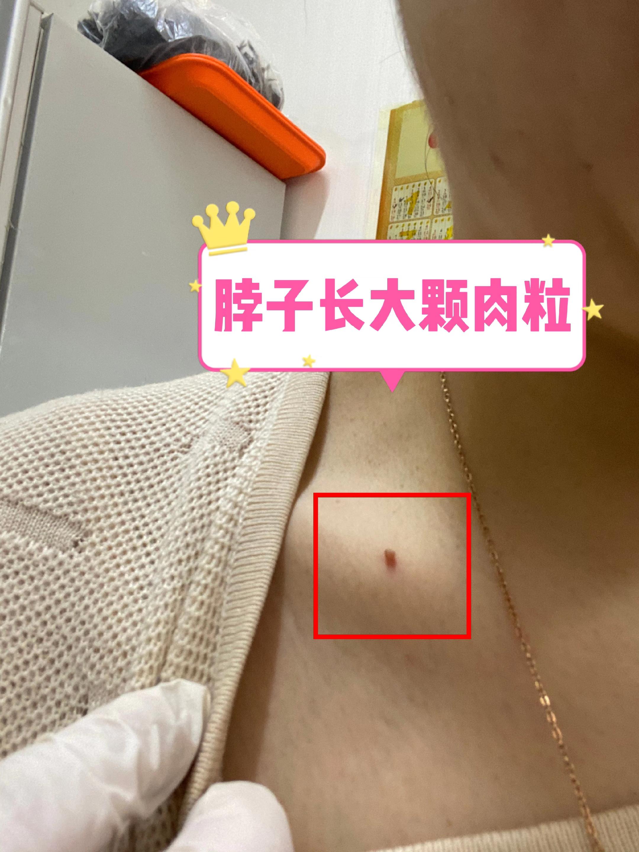 脖子上长颗大肉粒。#小肉粒#丝状疣 #扁平疣 #脖子上的小肉粒 #丝状疣祛除