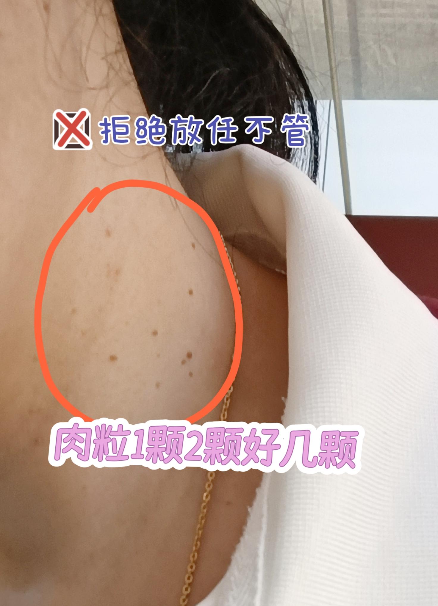 脖子上长肉粒。干干净净的脖子美美哒咯!#小肉粒 #小肉粒怎么处理 #丝状疣 #丝状疣祛除 #脖子上的小肉粒