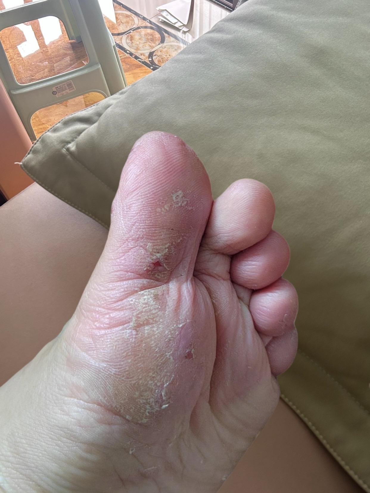 #皮肤 #脚部健康 #手脚干裂 #日常分享 #推给有需要的人