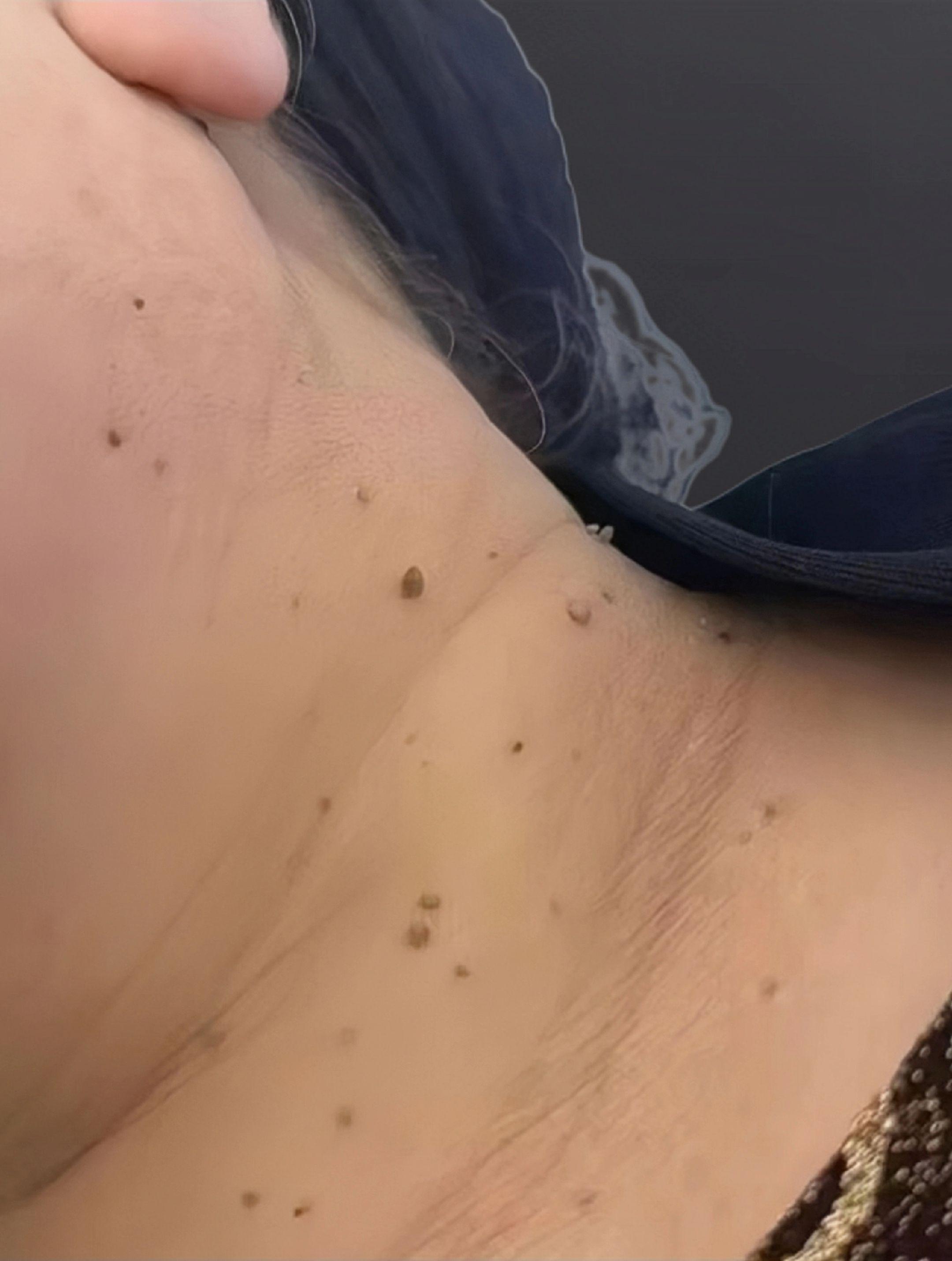 闺蜜说,脖子干净了,终于可以穿低领衣服出门了#每日分享 #露锁骨