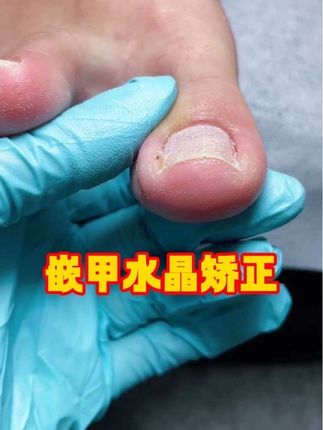 水晶矫正|拯救嵌甲的神!!! 水晶矫正真的太厉害了!效果巨明显!!  和嵌甲疼痛说拜拜👋切记千万不要修剪过度!#嵌甲水晶 #水晶矫正 #嵌甲水晶矫正