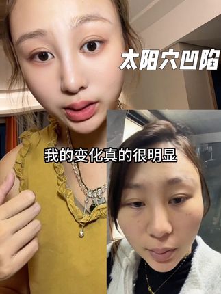 咬合过程中一定要拖住下巴,让上牙发力,莫名其妙的变化#太阳穴凹陷 #亲测分享 #面部瑜伽