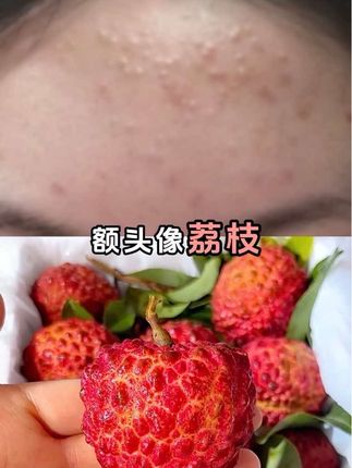如果你脸这样,恭喜你找到本命痘痘精华了!! #精华 #精华推荐 #油皮 #学生党好物推荐 #油痘肌