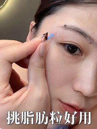 爱长脂肪粒的,都去试试#日常分享 #亲测 #脂肪粒去除小妙招 #脂肪粒处理 #脂肪粒疙瘩