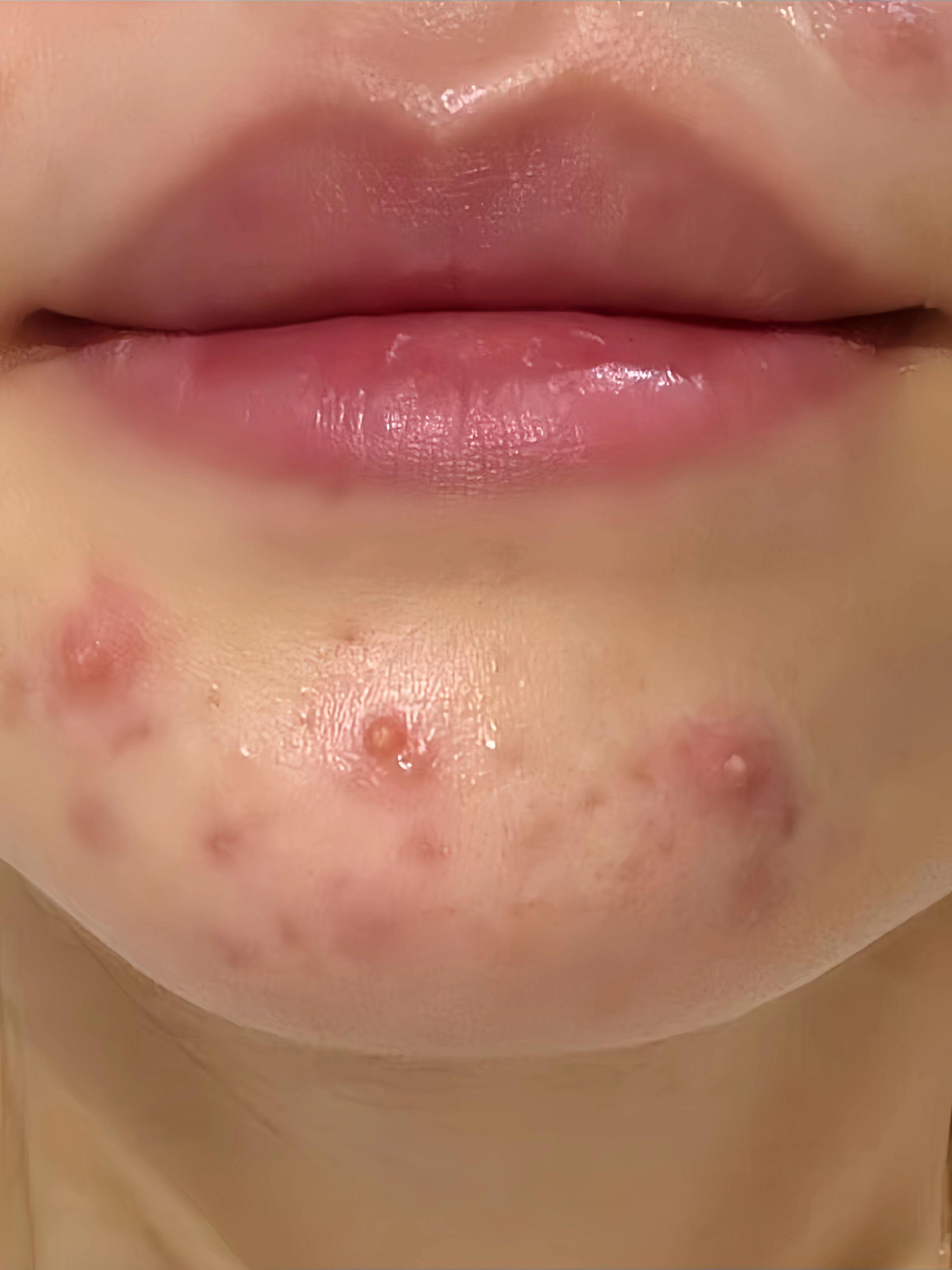 脸上总是爱长痘,不管是红肿痘还是硬块痘,都试试它!香港大药房草本植物祛痘膏,里面添加了多种植物萃取成分,能深入到皮肤底层,抑制油脂分泌,平衡水油,温和祛痘。质地很清爽,抹开就吸收了,一点也不会油腻,坚持使用,还你一个干净的脸蛋,趁现在赶紧入手吧!#好皮肤养出来 #每日分享