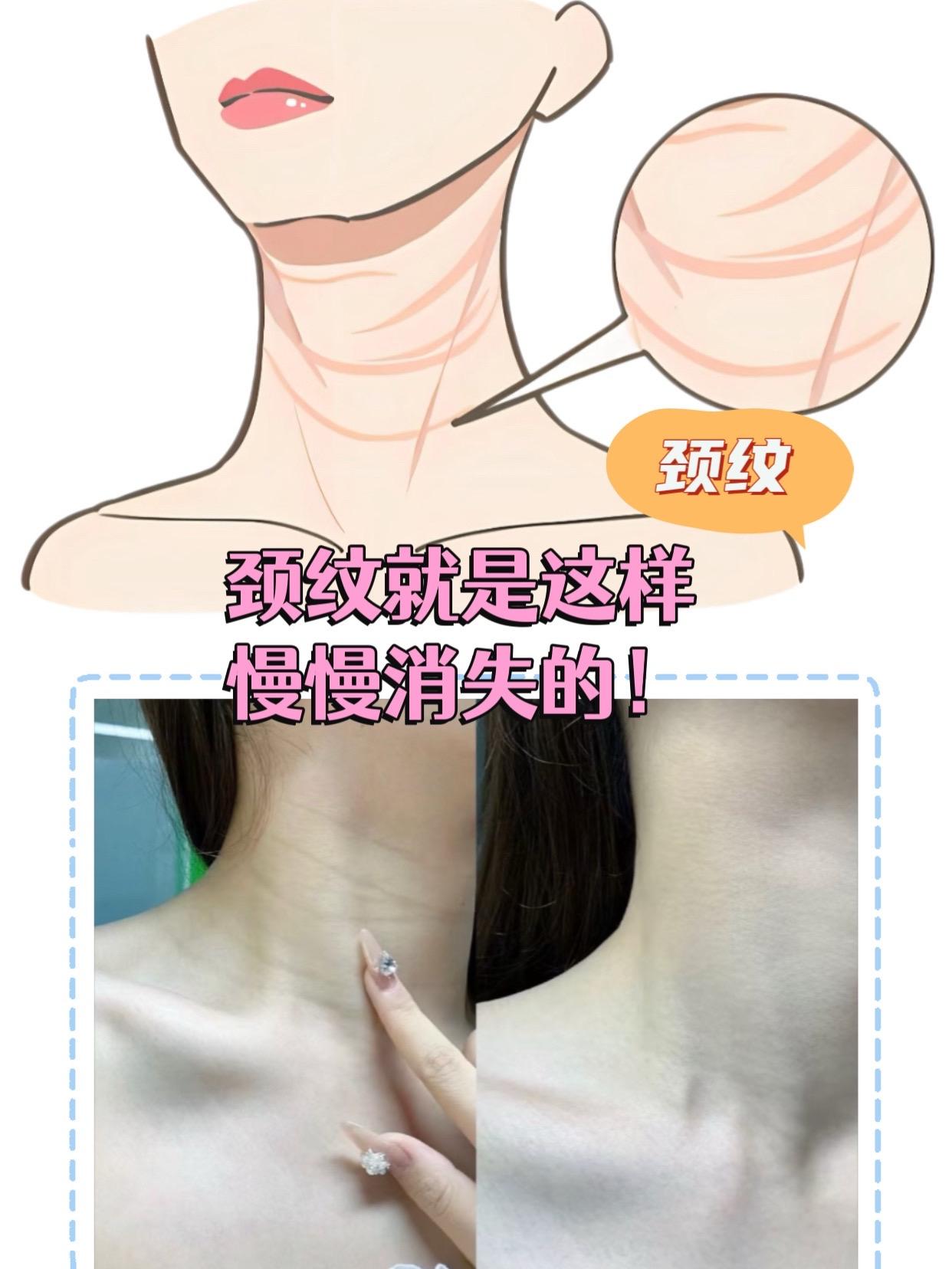 #颈纹 #袋鼠妈妈 #长纹 #强烈推荐 #颈霜