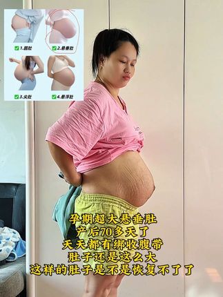 孕期超大悬垂肚 剖腹产 产后70多天了 天天都有绑收腹带 肚子还是这么大 这样的肚子是不是恢复不了了#产后恢复 #剖腹产 #产后妈妈 #悬垂肚 #只有经历过的人才会懂