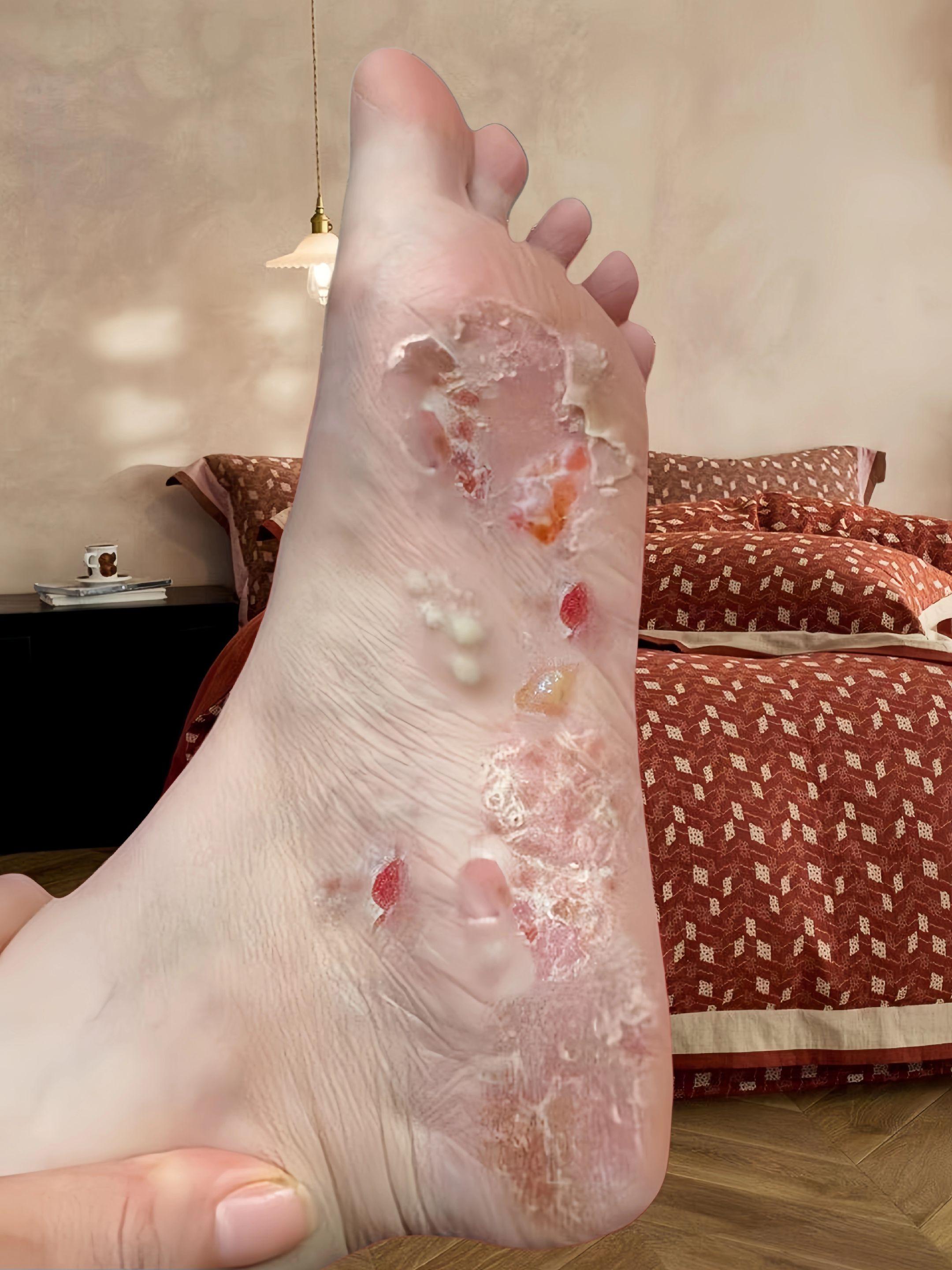 终于不痒了,不臭了,真的好开心!#足部护理#无处安放的小脚丫 #夏天该有的样子#自信最美