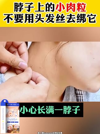 去疣黑科技!睡前涂,睡醒撕,简单又有效 #丝状疣祛除 #颈部护理 #脖子上的小肉粒 #小肉粒脖子上腋窝下的小肉粒不要用手去揪了 #夏日必备 