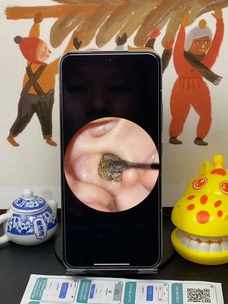结婚十八年了,终于知道老婆的秘密了,每次洗澡都用棉签掏耳朵,掏不出来,还容易残留棉絮,跟耳垢搅拌成混凝土,变成耳耵聍堵在耳道里面,怎么掏也掏不出来,耳朵不能要了啊#可视掏耳勺 #掏耳朵好舒服 #掏耳神器 #耳朵 #广东dou知道