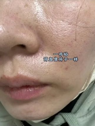 但凡你早点知道这个#国货 也不至于被毛孔粗大困扰这么多年!#脸部护肤 #精华水 #毛孔粗大