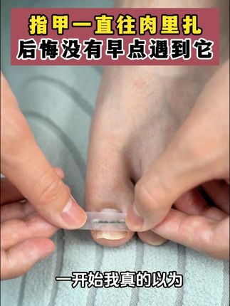 嵌甲就用正甲贴,在家处理不花冤枉钱#嵌甲#甲沟炎#国货