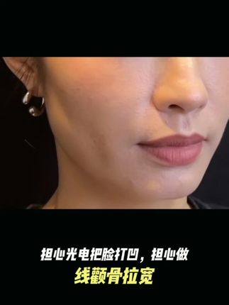担心光电把脸打凹,担心做线颧骨拉宽 ZHQ #柯琳妮尔 #好皮肤养出来 #护肤分享 #保养秘诀 #变美