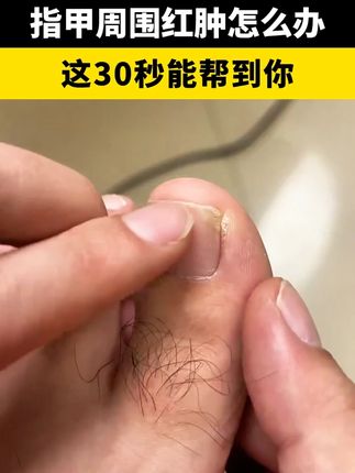 甲沟炎指甲红肿疼痛,这个方法帮你改善它#甲沟炎 #甲沟炎红肿疼怎么处理 #嵌甲 #嵌甲怎么抠出来 #拔甲