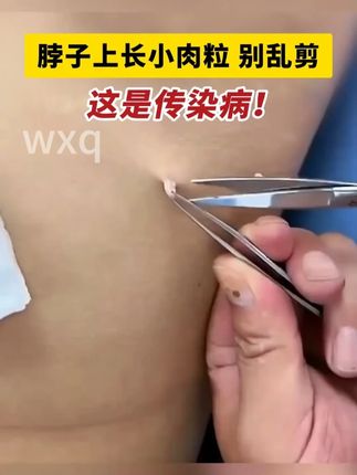 脖子上长了小肉条会传染,试试这个方法,后悔没有早知道! #hpv 脖子上长了小肉条会传染,试试这个方法,后悔没有早知道!#丝状疣 #丝状疣祛除 #脖子上的小肉粒 #疣