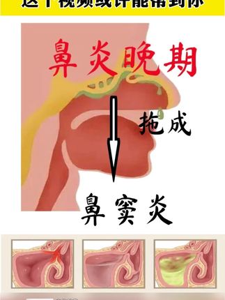 改善1年鼻炎、3年鼻炎、5年鼻炎,每日贴一次,简单好用!#鼻炎