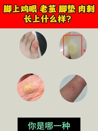 改善鸡眼其实不难 用对方法很重要 #专业修脚 #鸡眼 #鸡眼去除小妙招 zrl