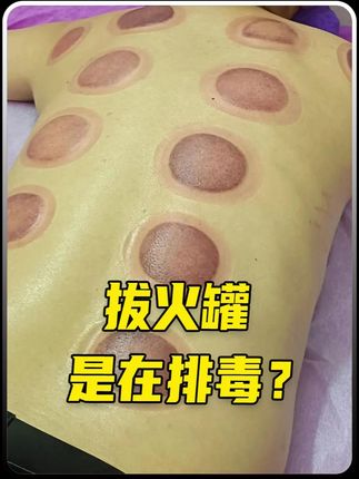 拔火罐和刮痧的工作原理是什么?这两个项目真的有用吗?#科普 #拔火罐 #刮痧 #中医养生 #健康科普