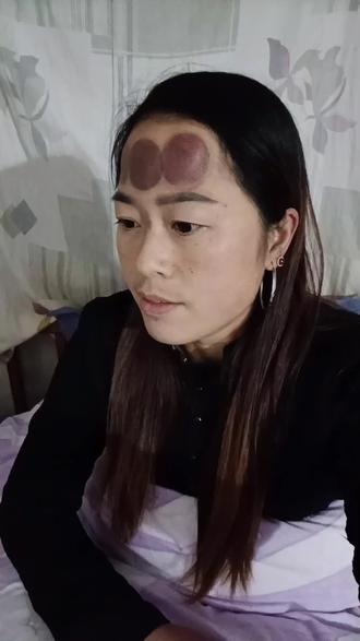 我的额头拔火罐原因是头疼 #难过的时候我学会了独自承受