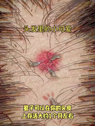 仁和药业百部酊喷雾剂男女阴用成人祛除虱子虱卵虱立净一扫光正品#长虱子怎么消除#消除虱子卵的小妙招#身上长虱子怎么消除#草本植物#百部酊喷剂