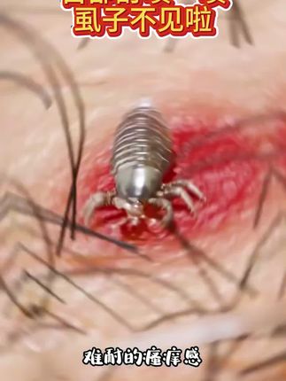 仁和药业百部酊喷雾剂男女阴用成人祛除虱子虱卵虱立净一扫光正品#长虱子怎么消除 #消除虱子卵的小妙招 #身上长虱子怎么消除 #草本植物 #百部酊喷剂