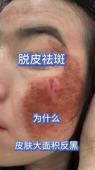 脱皮祛斑,皮肤为什么大面积反黑?#脱皮祛斑的危害 #排色液干排#祛斑反黑了能恢复吗 #祛斑反黑怎么补救