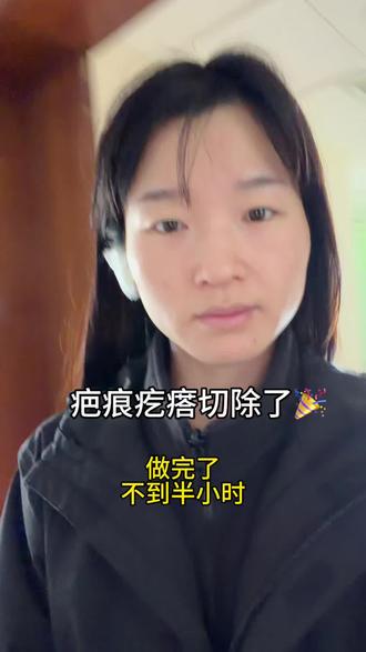 疤痕疙瘩终于切掉了#增生疤痕 #打耳洞 #耳洞增生 #耳洞增生疙瘩 #耳洞增生怎么消除