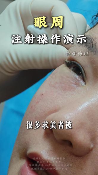 眼周细纹 👇⬇️温馨提示:效果因人而异,肖像授权齐全。内容无医疗项目推广,所有出镜人员均已成年且年满25周岁。#广州陈坦 #注射 #眼周抗衰 #眼尾细纹
