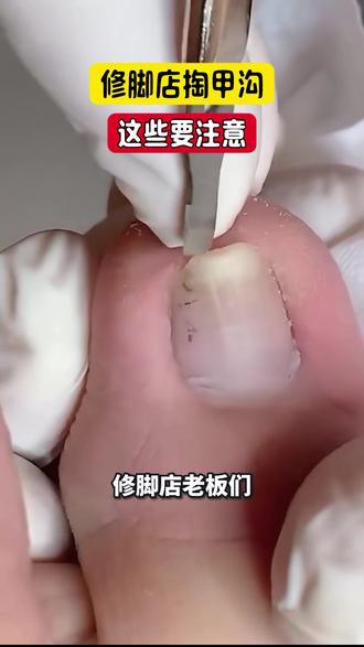 修脚店掏甲沟,这些要注意! #新甲 #修脚 #修脚培训 #修脚加盟 #手足护理