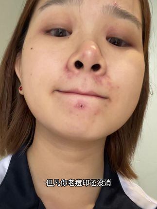 rnw你好样的!都给我去用它 #祛痘精华 #学生党 #痘肌 #rnw祛痘精华