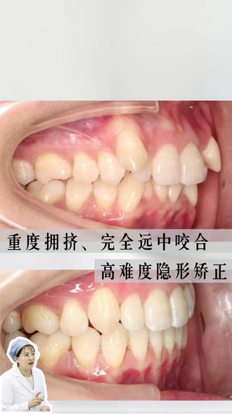 重度拥挤!咬合完全远中咬合关系!隐形矫正要配合要戴够时间! #牙齿矫正 #隐形矫正 #正畸 #佛山牙齿矫正 #广州牙齿矫正