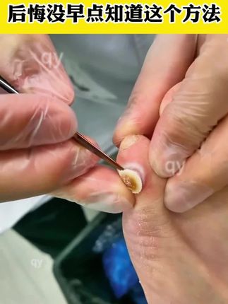 脚上鸡眼越长越深,后悔没有早点知道这个方法#鸡眼 #鸡眼跖疣 #鸡眼去除小妙招 #老茧 #老茧怎么去除