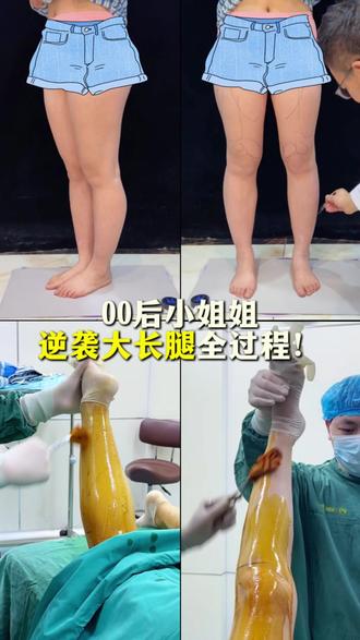 00后小姐姐直腿逆袭过程来了 #直腿术 #卢九宁