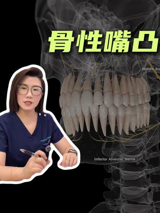 骨性嘴凸正畸,隐形牙套1年能内收多少? 骨性嘴凸一直是比较困难的正畸问题,但只要利用好生物力学原理、设计好控根内收,隐形矫正仅1年就可以有比较明显内收。所以更关键的问题要放在【内收多少?】上,这决定了结果是否贴合个人五官气质、面型是否协调
-
很多人不知道,其实性别也是一个要重点考虑的维度,通常相较于女生,男生应该要更克制内收量,保留一定的凸度,这样的轮廓感,是能更好体现男性的阳刚气质的。
-
为什么能更快完成内收?还有那些美学细节要考虑?一起来听听吧
-
#广州正畸 #嘴凸矫正 #骨性嘴凸正畸思路#微笑美学正畸
