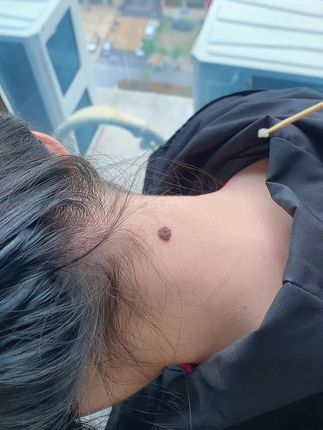 #经验分享 #精致女人必备 #脖子上的小肉粒