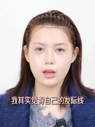 发际线本身不是特别高,但是山羊角光秃,不想再有刘海了?
她植发后拍照真的不用P发际线了!