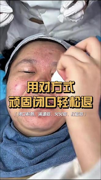 顽固闭口用对方式轻松退 额头口周密密麻麻的闭口农场,脸颊红红敏敏,混合喵星人的满源包,选对方式很重要!#护肤 #闭口粉刺 #油敏肌